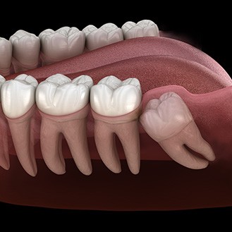 Illustration of wisdom tooth growing in at an angle