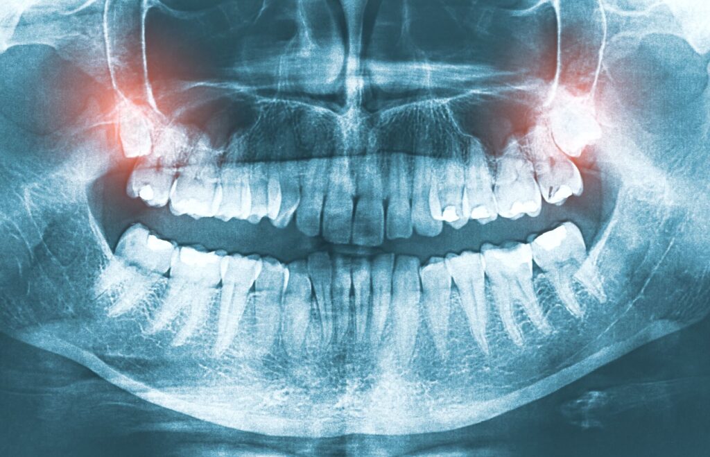 X-ray showing upper wisdom teeth glowing red